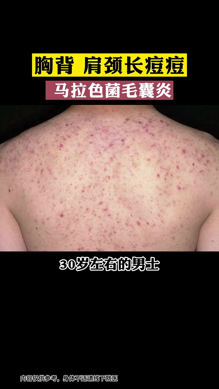 痘痘前胸後背肩頸長痘痘其實是馬拉色菌毛囊炎