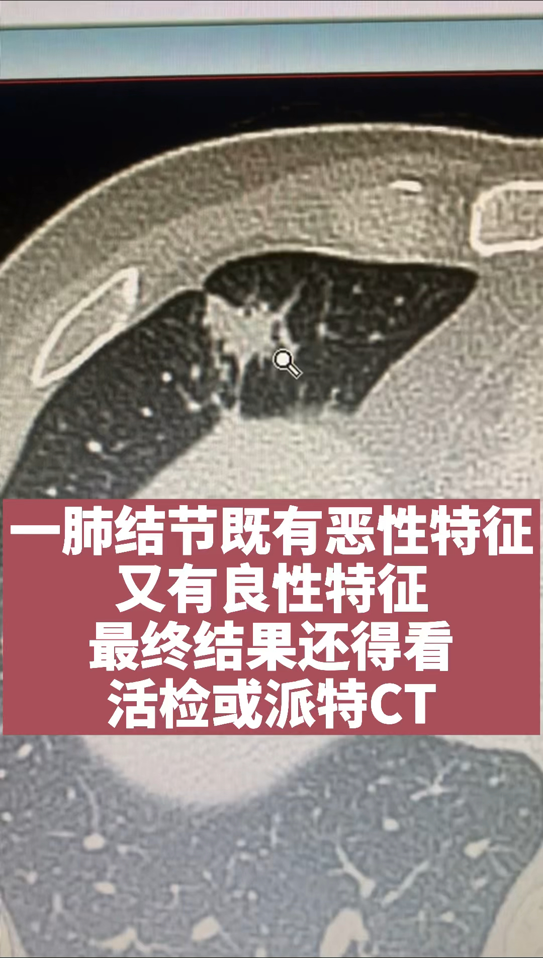 健康養生一肺結節既有惡性特徵又有良性特徵最終結果還得看活檢或派特