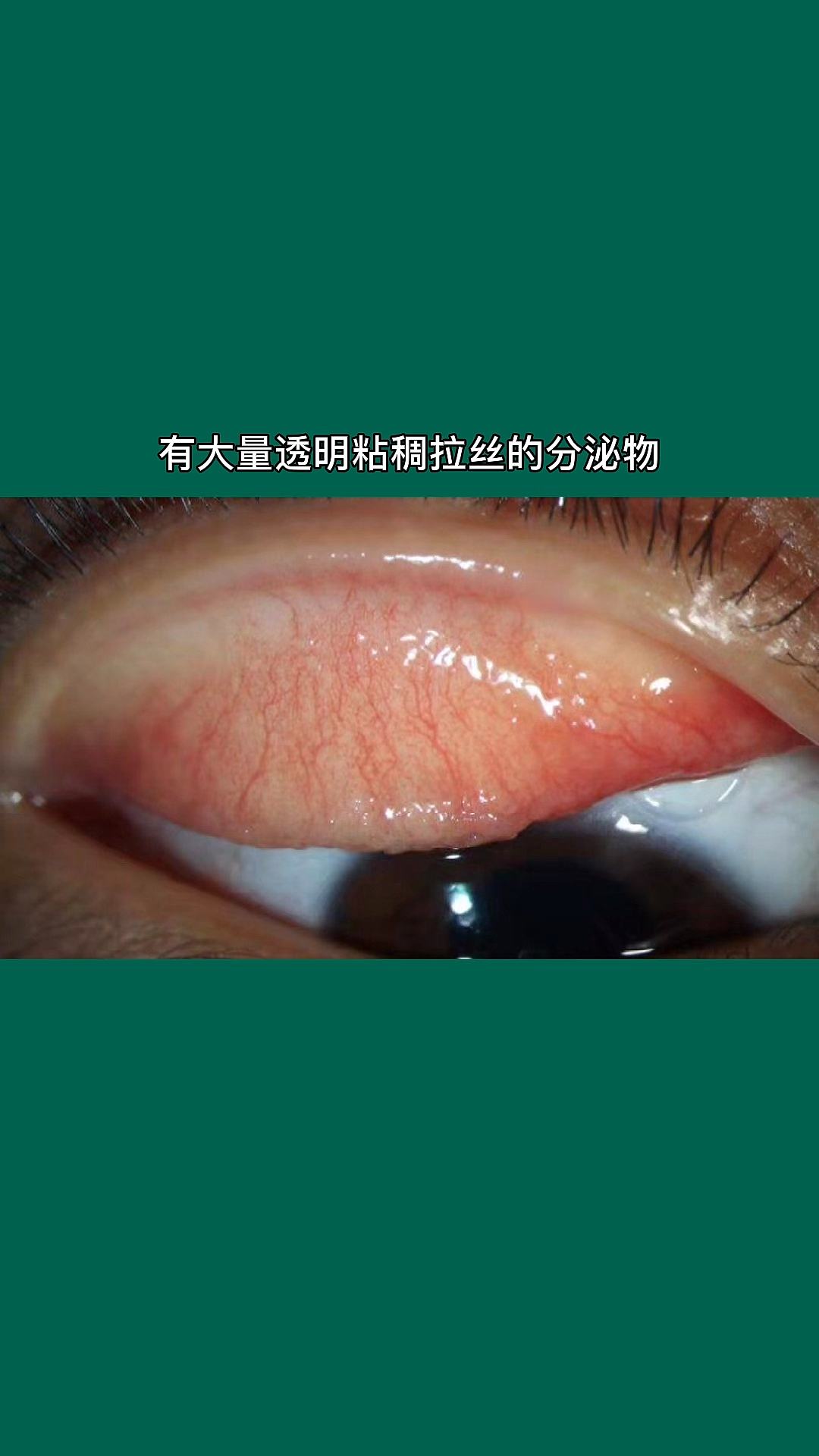 护眼知识春季要注意过敏性结膜炎