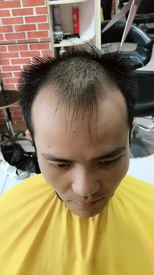 最牛的改变秃顶剪完秒变男神