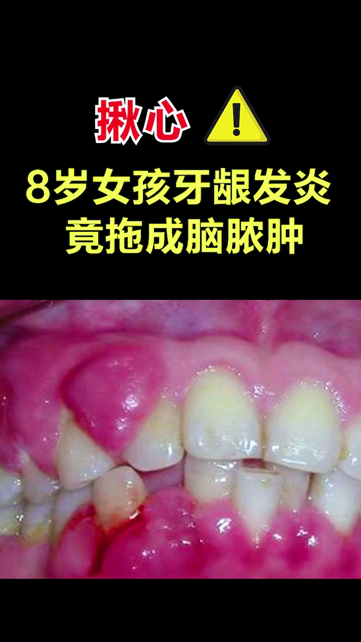 育儿孩子牙龈发炎你还敢不重视小心后悔终身