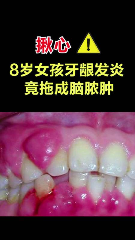 育儿孩子牙龈发炎你还敢不重视小心后悔终身