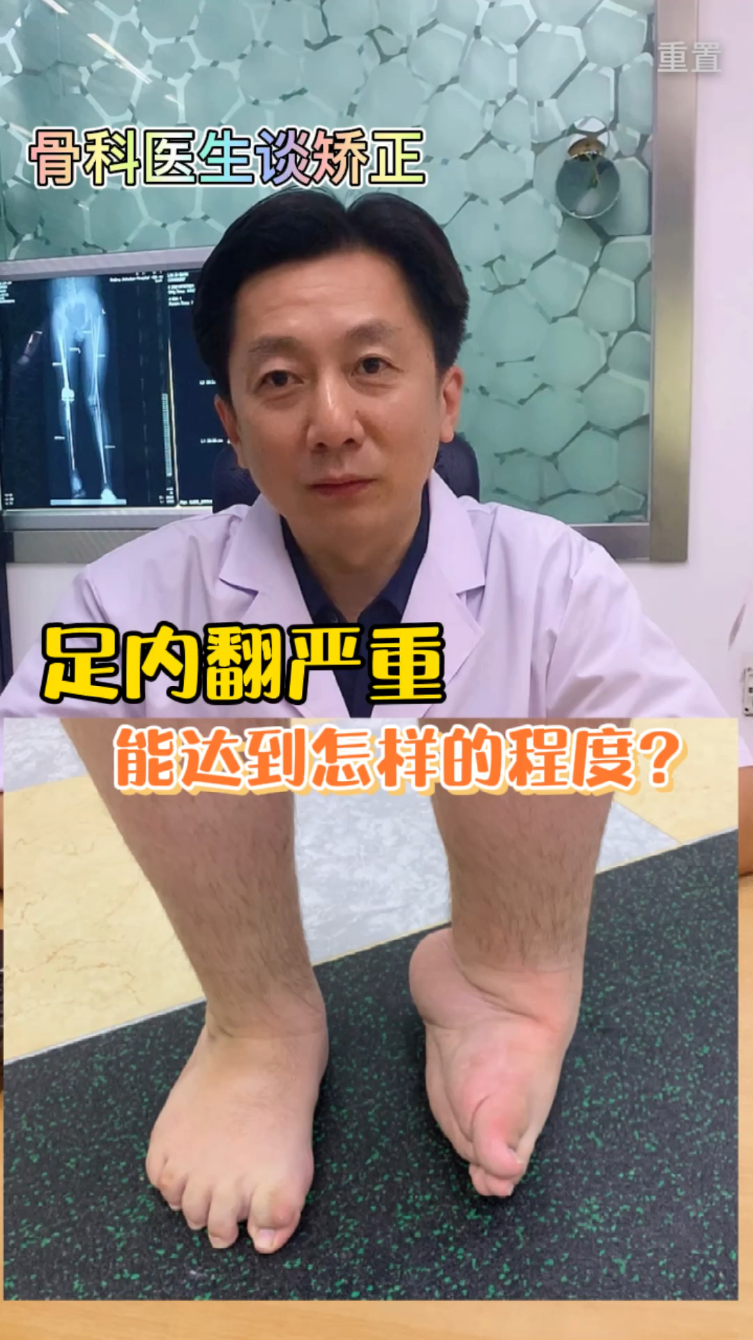 健康科普#儿童足内翻严重,能达到什么程度?