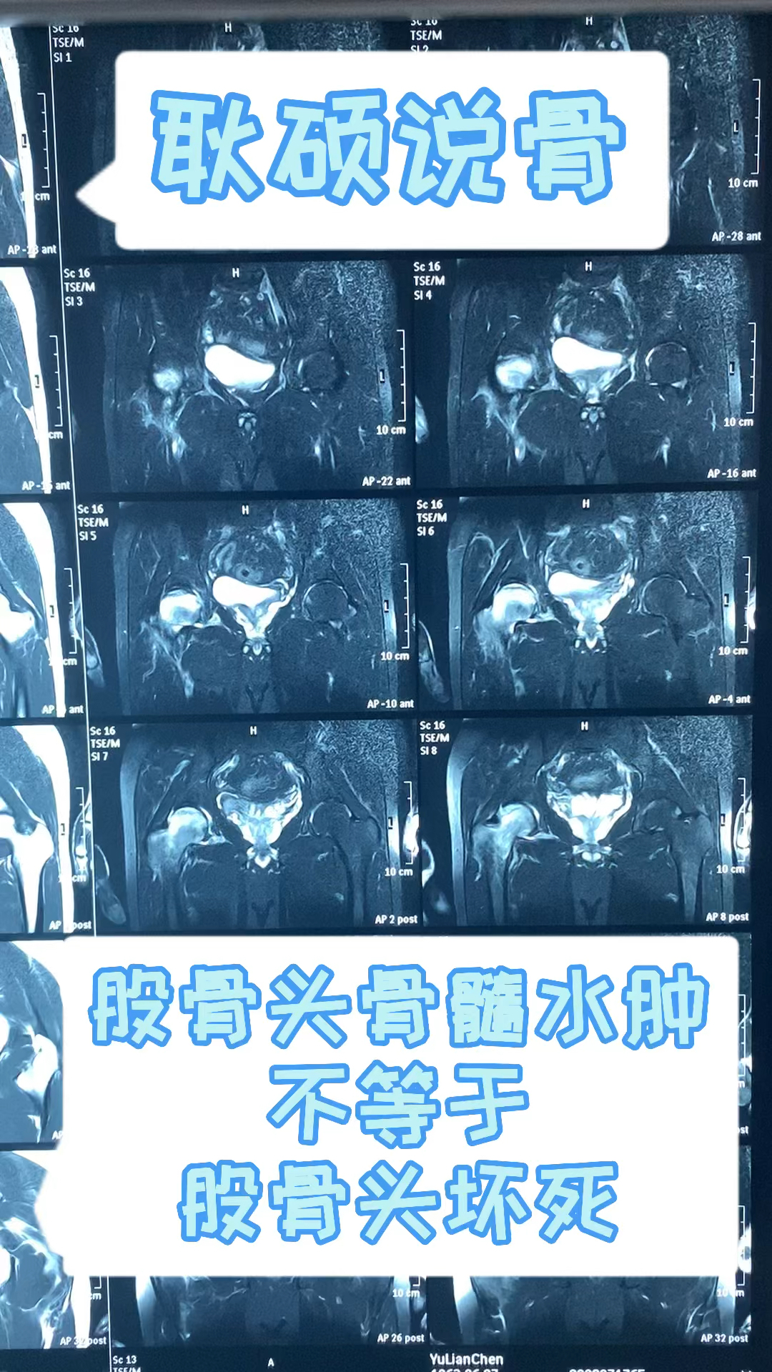 股骨头坏死股骨头骨髓水肿就是股骨头坏死吗