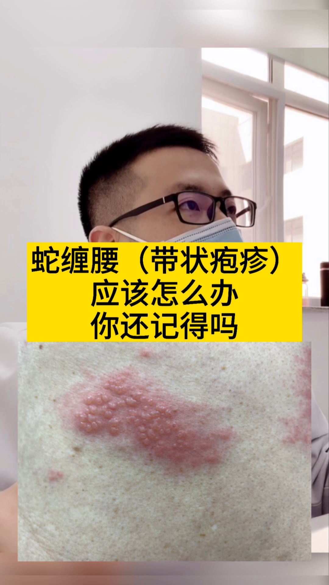 医学科普#得了蛇缠腰你知道怎么办吗,具体处理方法可参考8月3日视频!