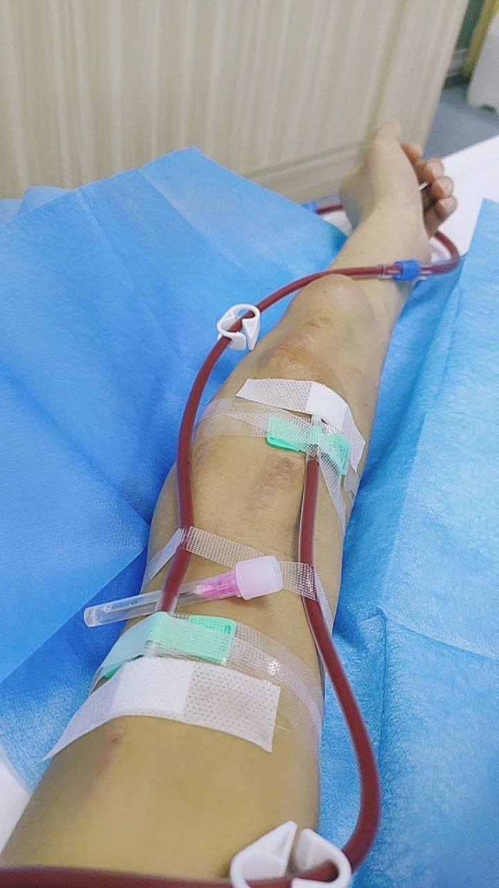 尿毒症患者加油#尿毒症已经打了两针上血液透析机了,连续透析四个