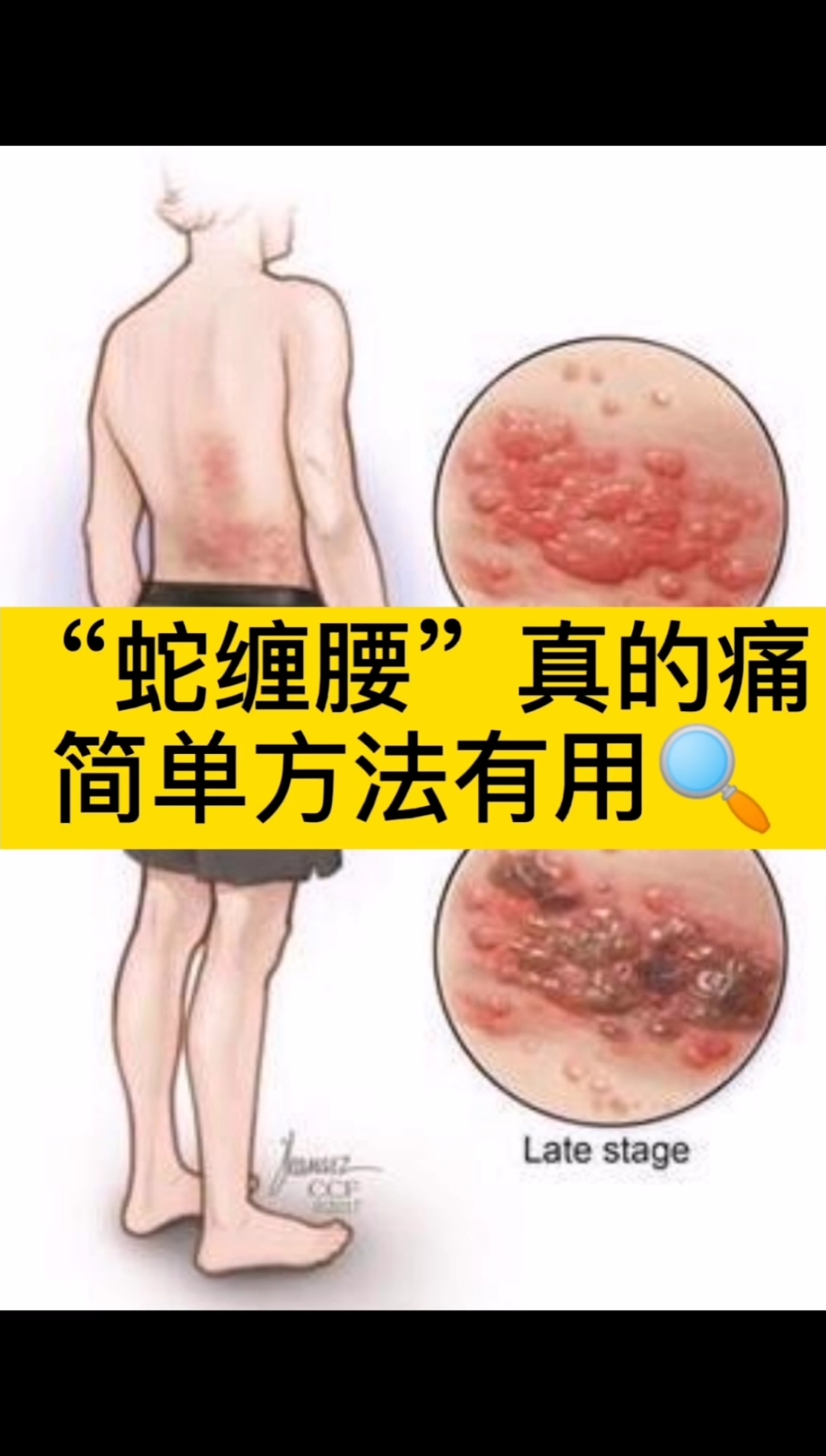 每天一点冷知识#身边很多中老年人中招"蛇缠腰",其实这在医学叫带状