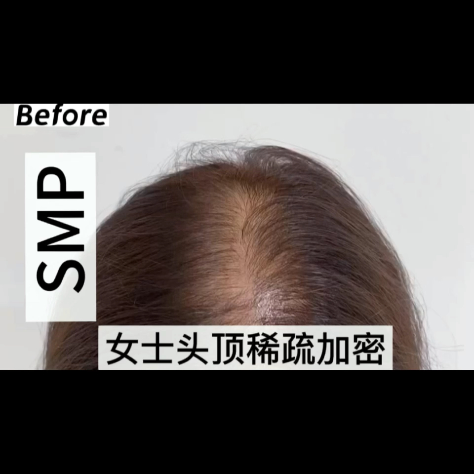 泉州哪里有纹发#来自泉州女士头顶稀疏纹发加密,福建顶密时尚纹坊黄