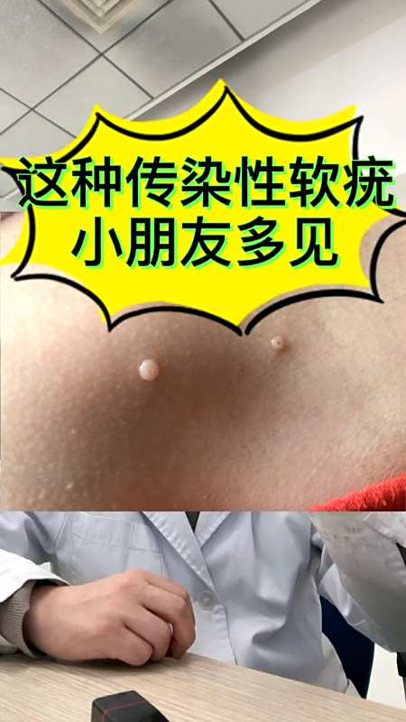 全民医生说#这种传染性软疣,小朋友最常见,家长要注意一下-度小视
