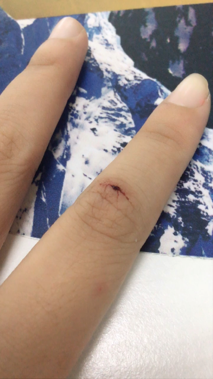 女儿的手不小心被剪刀剪伤了!好心疼呀.