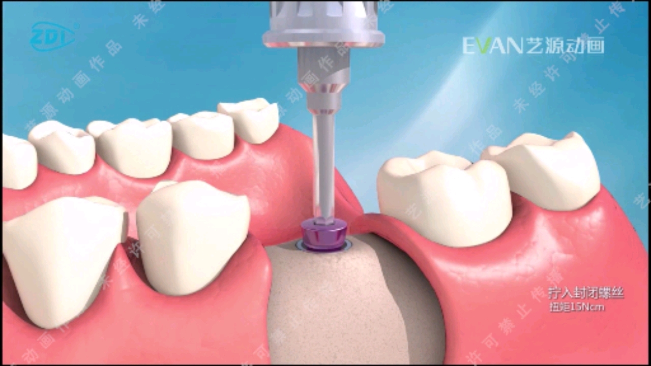 三维动画#种植牙医疗三维动画演示