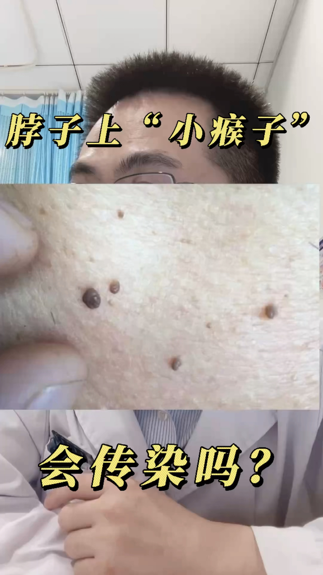 全民医生说脖子上长了好多的小瘊子它们会传染吗