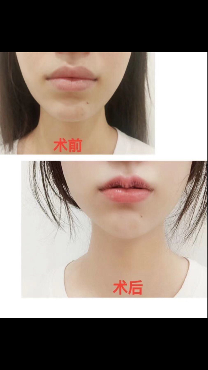 m唇#m唇前后对比