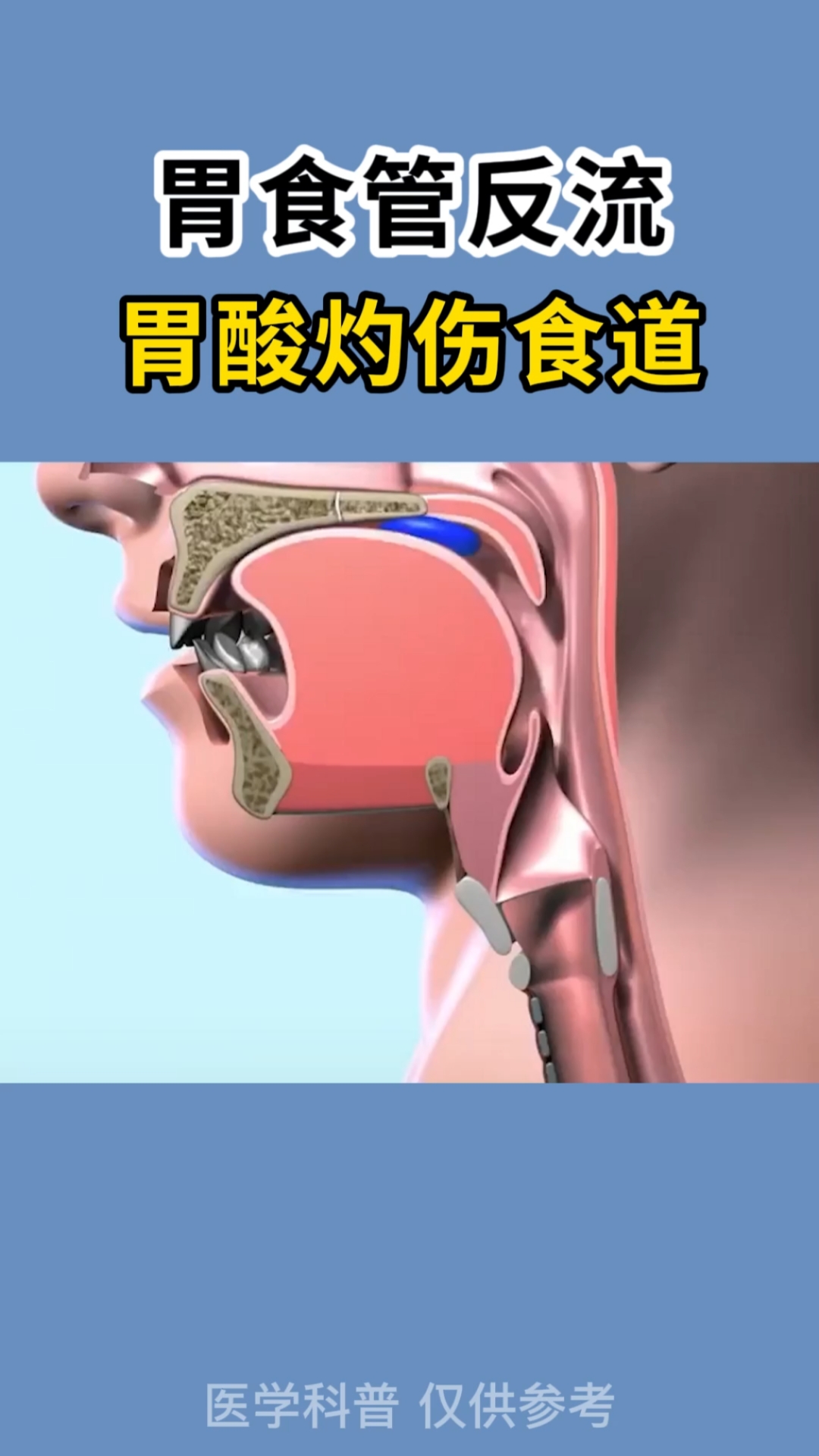 脾胃动画演示胃食管反流这几点要注意