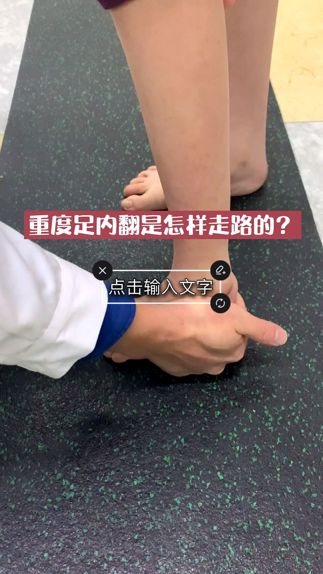 育儿重度足内翻同时有跟腱挛缩的孩子是怎样一种步态表现