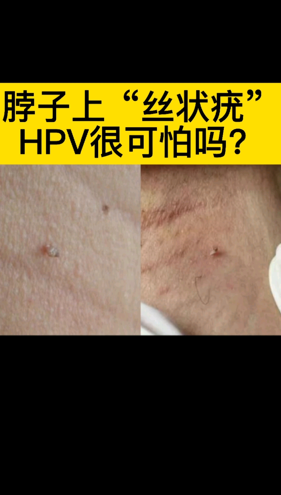 不一样的人生#脖子上长hpv,吓我一跳-度小视