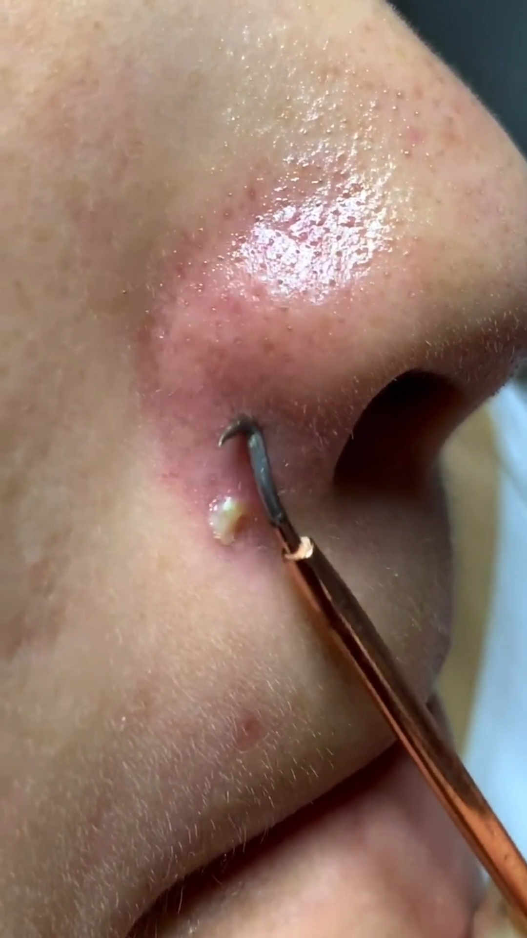 脓包痘痘#一招教你们解决脓包痘痘