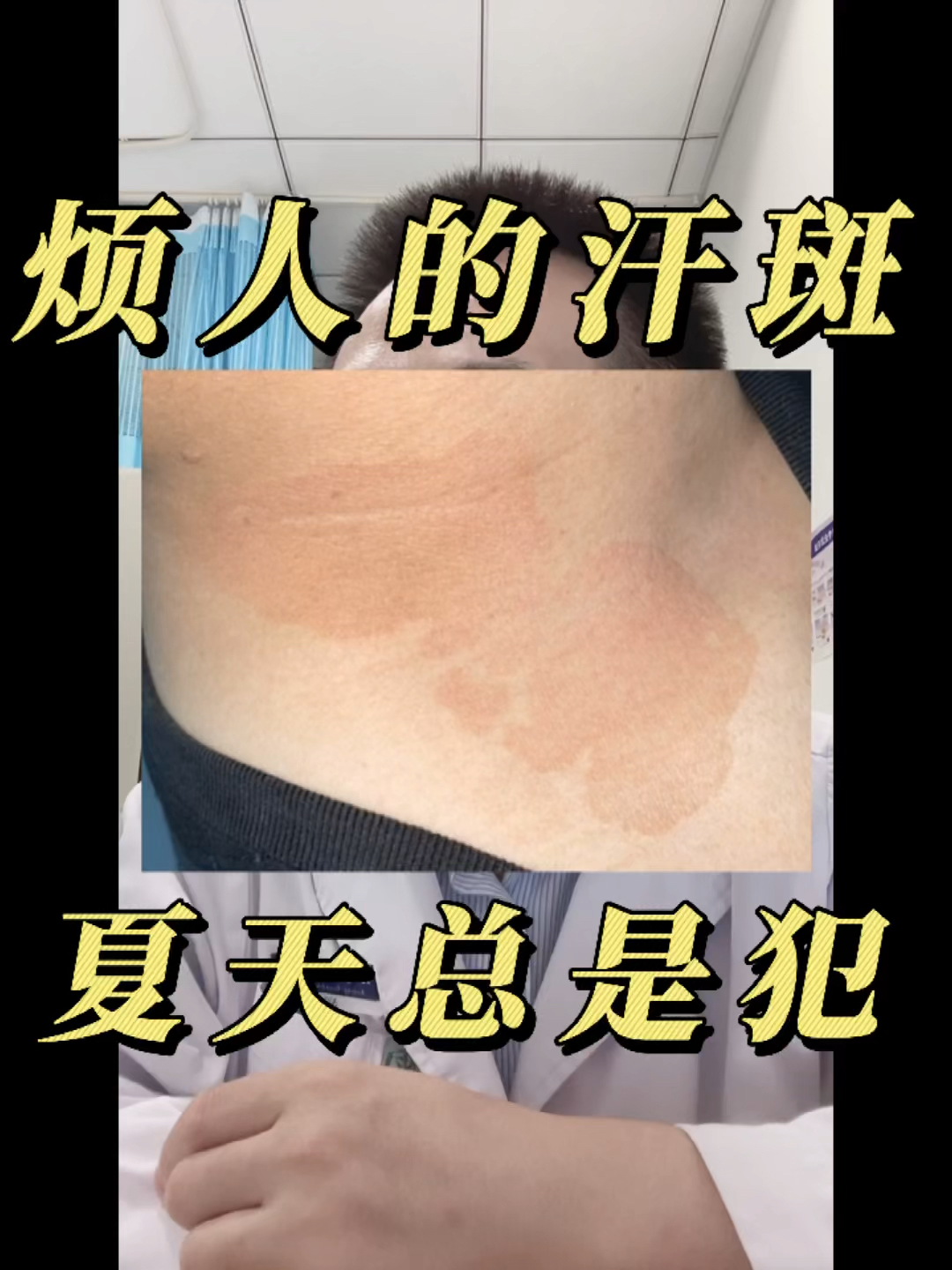 全民医生说汗斑不是出汗多而是真菌感染